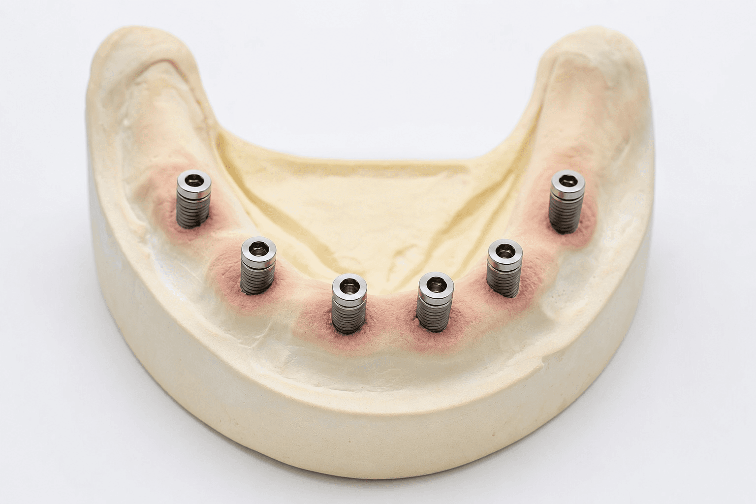 Panoramic X-ray of dental implants